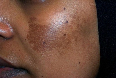 Melasma