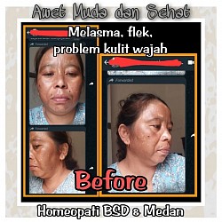 Melasma sebelum pengobatan