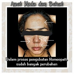 Sesudah. Banyak bagian yang melasma menghilang dan hilang total